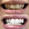 Diamond Smile-resultat Före och efter tandblekningsremsor med aktivt kol för tandblekning
