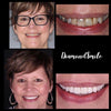 Äldre kvinna Före- och efterbilder av PAP+ tandblekningsgel från Diamond Smile