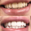 Tandblekning med Diamond Smile Teeth Bleaching Power+ Telefonblekning Munstycke - Mun med före och efter bild av vita tänder