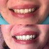 Erfarenhet av Diamond Smile lila tandblekning färgkorrigeringspenna - mun med före och efter bild av vita tänder