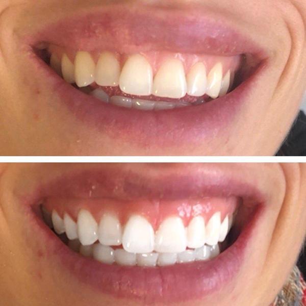 Vita tänder efter blekning med ett tandblekningskit.