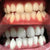 Vita tänder genom tandblekning. Bilder av en kvinna efter tandblekning.