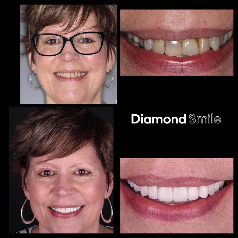 Diamond Smile tandblekningsupplevelse - Kvinna med före- och efterbild av vita tänder