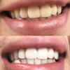 tandblekning aktiva kolremsor för att bleka tänderna
