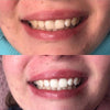 tandblekning aktiva kolremsor för att bleka tänderna
