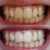 Vita och gula tänder. Vita tänder efter tandblekning med tandblekningsgel. Whitening tänder med tandblekning.