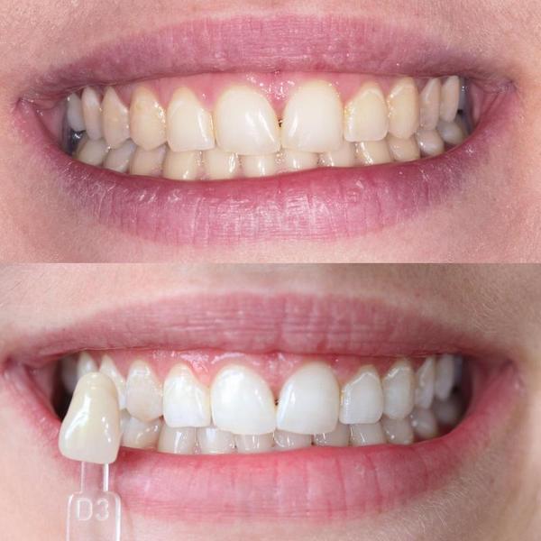 Vita tänder efter tandblekning med ett tandblekningskit och tandblekningsgel.