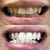 Tandblekning för vita tänder. Bilden visar en före- och efterbild av tänderna efter blekning.
