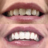 Vita tänder med tandblekningspenna - Tandblekning
