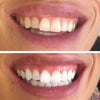 Tandblekningsremsor för vita tänder