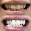 Tandblekningspenna för vitare tänder hemma