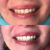 Vita tänder genom tandblekning