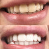 Vita och ljusa tänder genom Diamond tandblekning