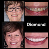 Diamond Smile tandblekningsupplevelse - Kvinna med före- och efterbild av vita tänder