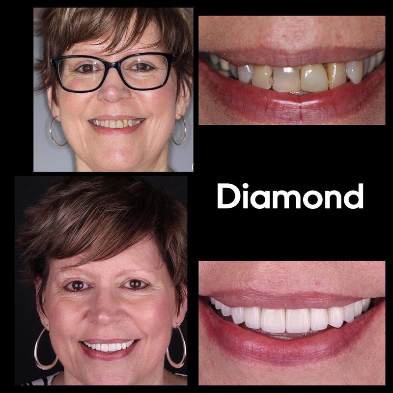 Diamond Smile tandblekningsupplevelse - Kvinna med före- och efterbild av vita tänder