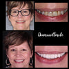 Tandblekning - Vita tänder